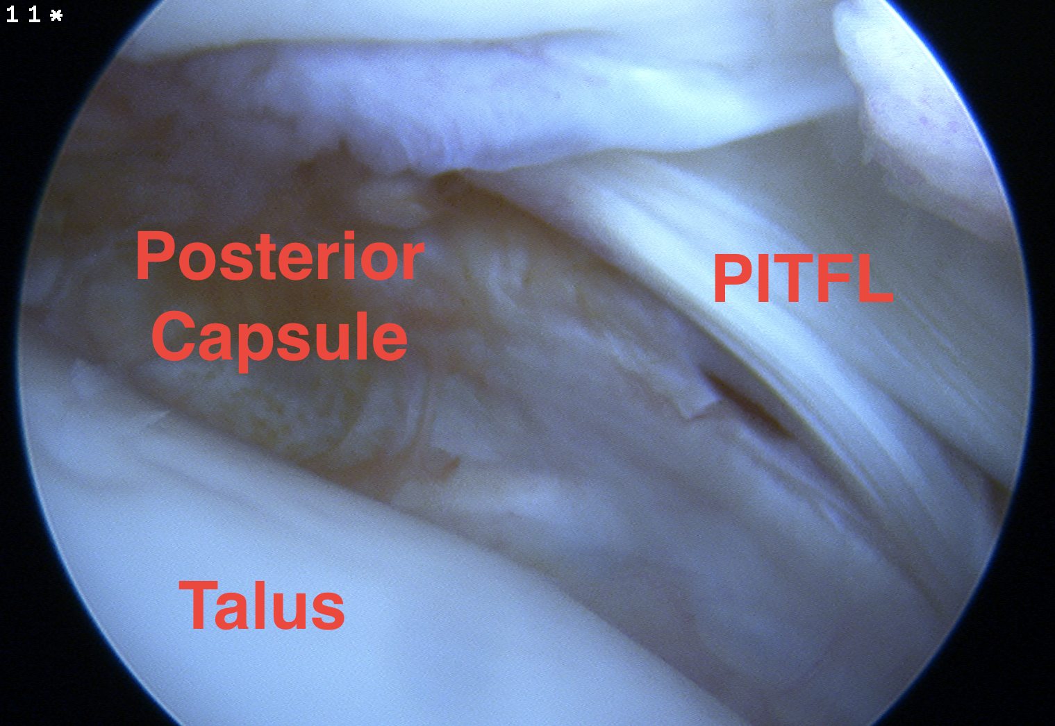 Ankle scope posterior capsule laterally